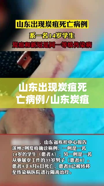 山东出现炭疽死亡病例/山东炭疽病毒事件 山东出现炭疽死亡病例/山东炭疽病毒事件