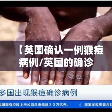 【英国确认一例猴痘病例/英国的确诊病例】 【英国确认一例猴痘病例/英国的确诊病例】