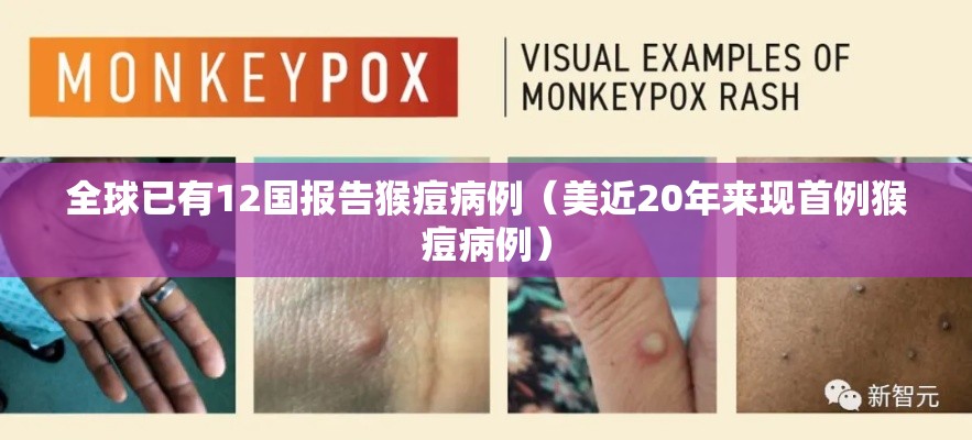 全球已有12国报告猴痘病例(美近20年来现首例猴痘病例) 全球已有12国报告猴痘病例(美近20年来现首例猴痘病例)