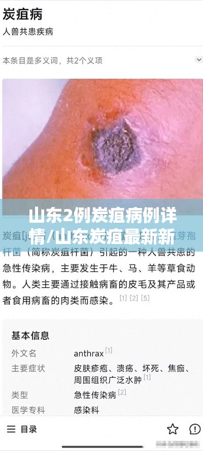 山东2例炭疽病例详情/山东炭疽最新新闻 山东2例炭疽病例详情/山东炭疽最新新闻