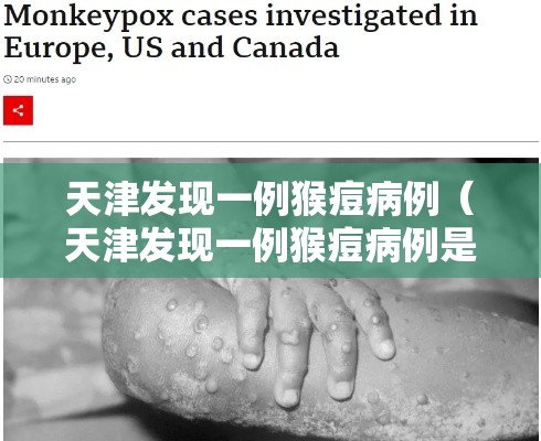 天津发现一例猴痘病例(天津发现一例猴痘病例是真的吗) 天津发现一例猴痘病例(天津发现一例猴痘病例是真的吗)