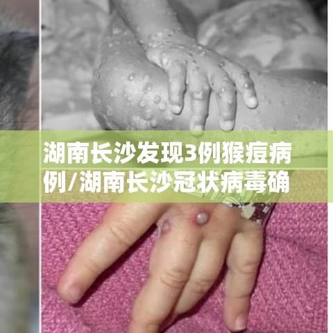 湖南长沙发现3例猴痘病例/湖南长沙冠状病毒确诊 湖南长沙发现3例猴痘病例/湖南长沙冠状病毒确诊