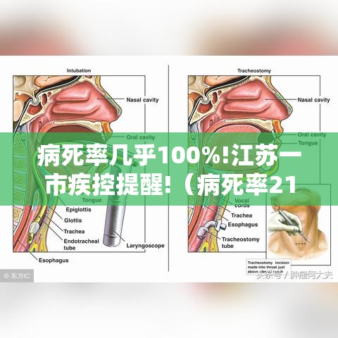 病死率几乎100%!江苏一市疾控提醒!(病死率21%) 病死率几乎100%!江苏一市疾控提醒!(病死率21%)