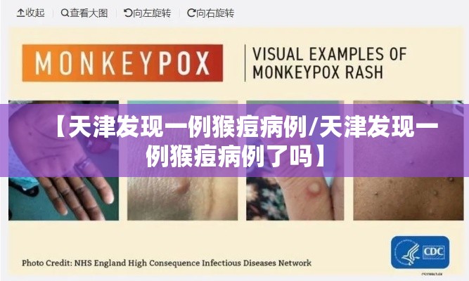 【天津发现一例猴痘病例/天津发现一例猴痘病例了吗】 【天津发现一例猴痘病例/天津发现一例猴痘病例了吗】