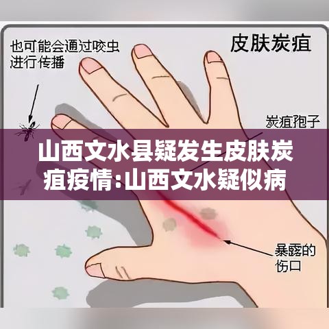 山西文水县疑发生皮肤炭疽疫情:山西文水疑似病例 山西文水县疑发生皮肤炭疽疫情:山西文水疑似病例