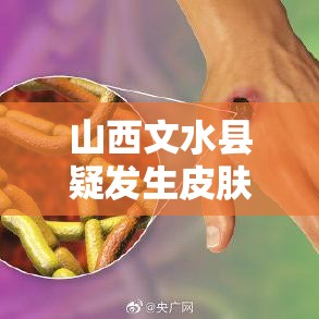 山西文水县疑发生皮肤炭疽疫情:山西文水疑似病例 山西文水县疑发生皮肤炭疽疫情:山西文水疑似病例