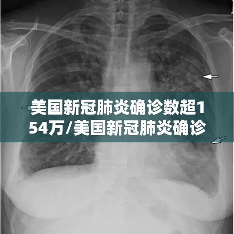 美国新冠肺炎确诊数超154万/美国新冠肺炎确诊超507万例 美国新冠肺炎确诊数超154万/美国新冠肺炎确诊超507万例